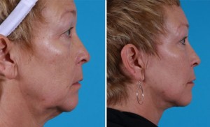 | Atlanta | Before and After Photos | Dr. Marcia Byrd