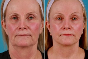 | Atlanta | Before and After Photos | Dr. Marcia Byrd