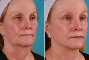 Mini Facelift | Atlanta | Patient 9 | Before and After Photos | Oblique View | Dr. Marcia Byrd