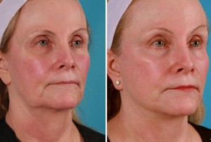 | Atlanta | Before and After Photos | Dr. Marcia Byrd