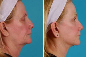Mini Facelift | Atlanta | Before and After Photos | Dr. Marcia Byrd