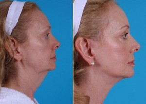 | Atlanta | Before and After Photos | Dr. Marcia Byrd