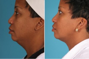 Neck Liposuction | Atlanta | Patient 2 | Before and After Photos | Side View | Dr. Marcia Byrd