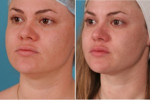 Neck Liposuction | Atlanta | Patient 3 | Before and After Photos | Oblique View | Dr. Marcia Byrd