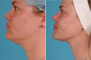 Neck Liposuction | Atlanta | Patient 3 | Before and After Pictures | Side View | Dr. Marcia Byrd