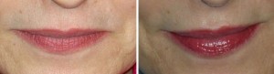 Permanent Makeup | Atlanta | Patient 6 | Before and After Photos | Dr. Marcia Byrd