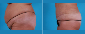Tummy Tuck | Atlanta | Patient 4 | Before and After Photos | Side View | Dr. Marcia Byrd