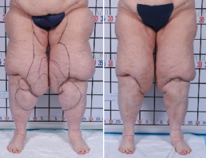 | Atlanta | Before and After Photos | Dr. Marcia Byrd