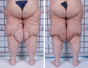 | Atlanta | Before and After Photos | Dr. Marcia Byrd
