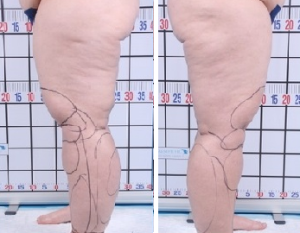 | Atlanta | Before and After Photos | Dr. Marcia Byrd