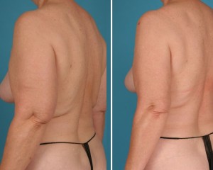 | Atlanta | Before and After Photos | Dr. Marcia Byrd