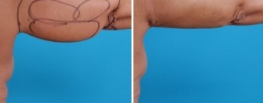 Arm Liposuction | Atlanta| Before and After Photos | Dr. Marcia Byrd