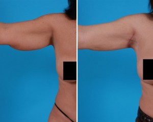 | Atlanta | Before and After Photos | Dr. Marcia Byrd