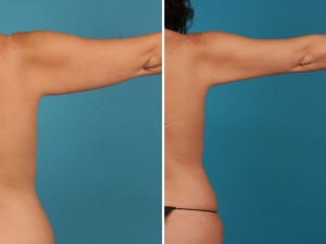 | Atlanta | Before and After Photos | Dr. Marcia Byrd