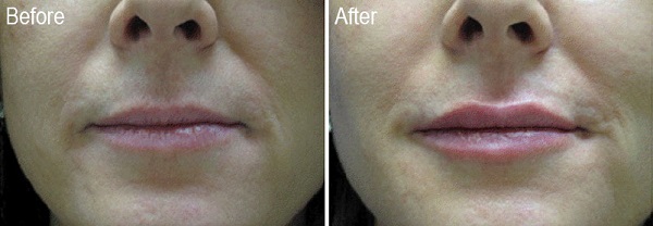 Restylane-Patient-2-Before-Dr.-Lisa-Bunin Restylane Lyft Before and After Photos