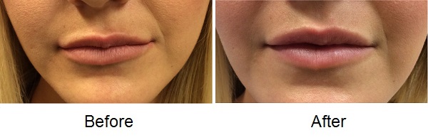Restylane Silk 1 71116 Restylane Lyft Before and After Photos