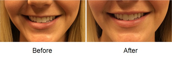 Restylane Silk 2 71116 Restylane Lyft Before and After Photos