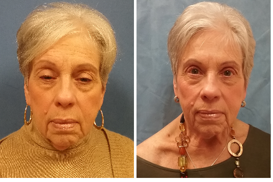 Ptosis-Blepharoplasty 2 Ptosis-Blepharoplasty 2