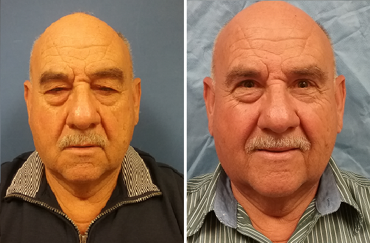 Ptosis-Blepharoplasty 3