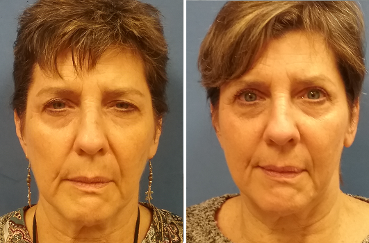 Ptosis-Blepharoplasty 4