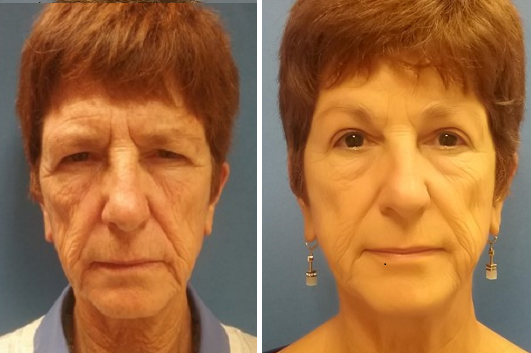 Blepharoplasty Patient 071519 b
