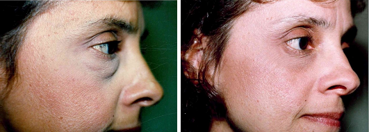 Blepharoplasty Patient 071519c