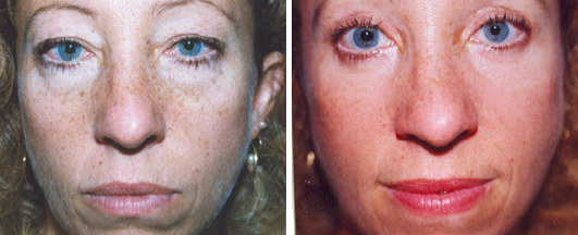 Blepharoplasty Patient | Allen Town, PA Invisible Blepharoplasty | Dr. Lisa Bunin