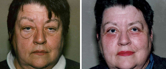 Blepharoplasty | Allentown, PA