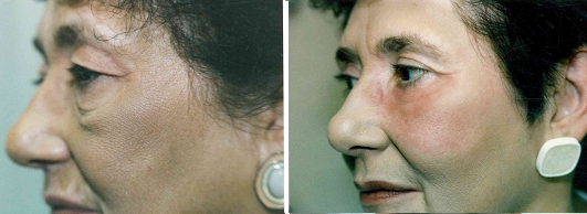 Allentown, PA | Eyelid Surgery