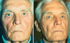 Eyelid Surgery | Allentown, PA