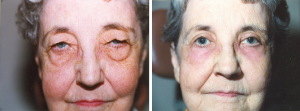 Dr. Lisa Bunin | Eyelid Surgery