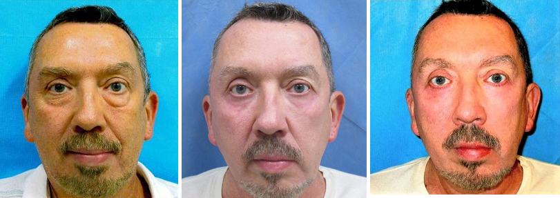 Blepharoplasty Festoons | Allentown, PA