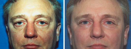 Blepharoplasty Patient | Dr. Lisa Bunin Allentown, PA | Eyelid Surgery