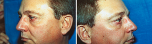 Allentown, PA | Blepharoplasty