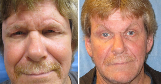 Blepharoplasty Patient | Dr. Lisa Bunin Allentown, PA | Blepharoplasty