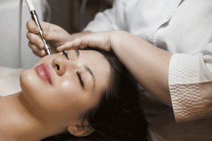 Microneedling with PRP