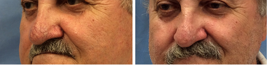 Patient | Dr. Lisa Bunin IPL Light Treatment