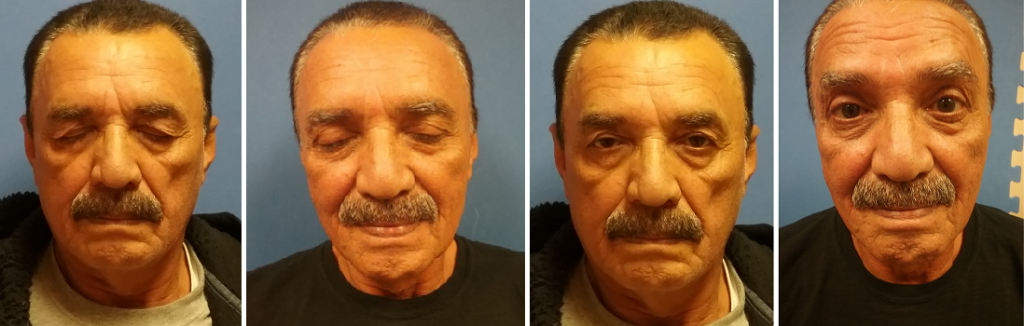 Ptosis-Blepharoplasty