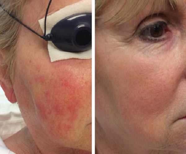 Rosacea Patient | Dr. Lisa Bunin IPL Light Treatment