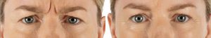 Xeomin before and after Xeomin before and after
