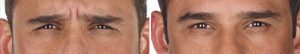 Xeomin before and after Xeomin before and after