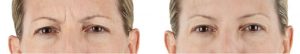 Xeomin before and after Xeomin