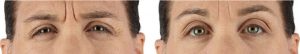 Xeomin Before and after Xeomin Before and After