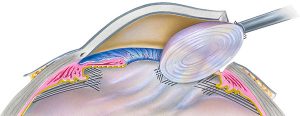 cataract lens replacement