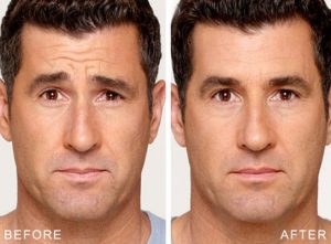 Dysport before and after man Dysport before and after