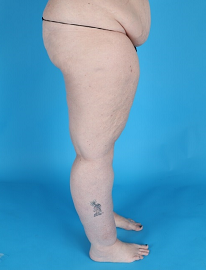 Lipedema Before and After