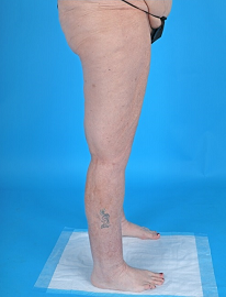 Lipedema Before and After