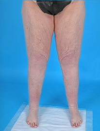 Lipedema