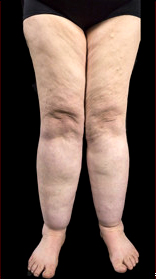 Stages of lipedema