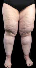 Stages of Lipedema